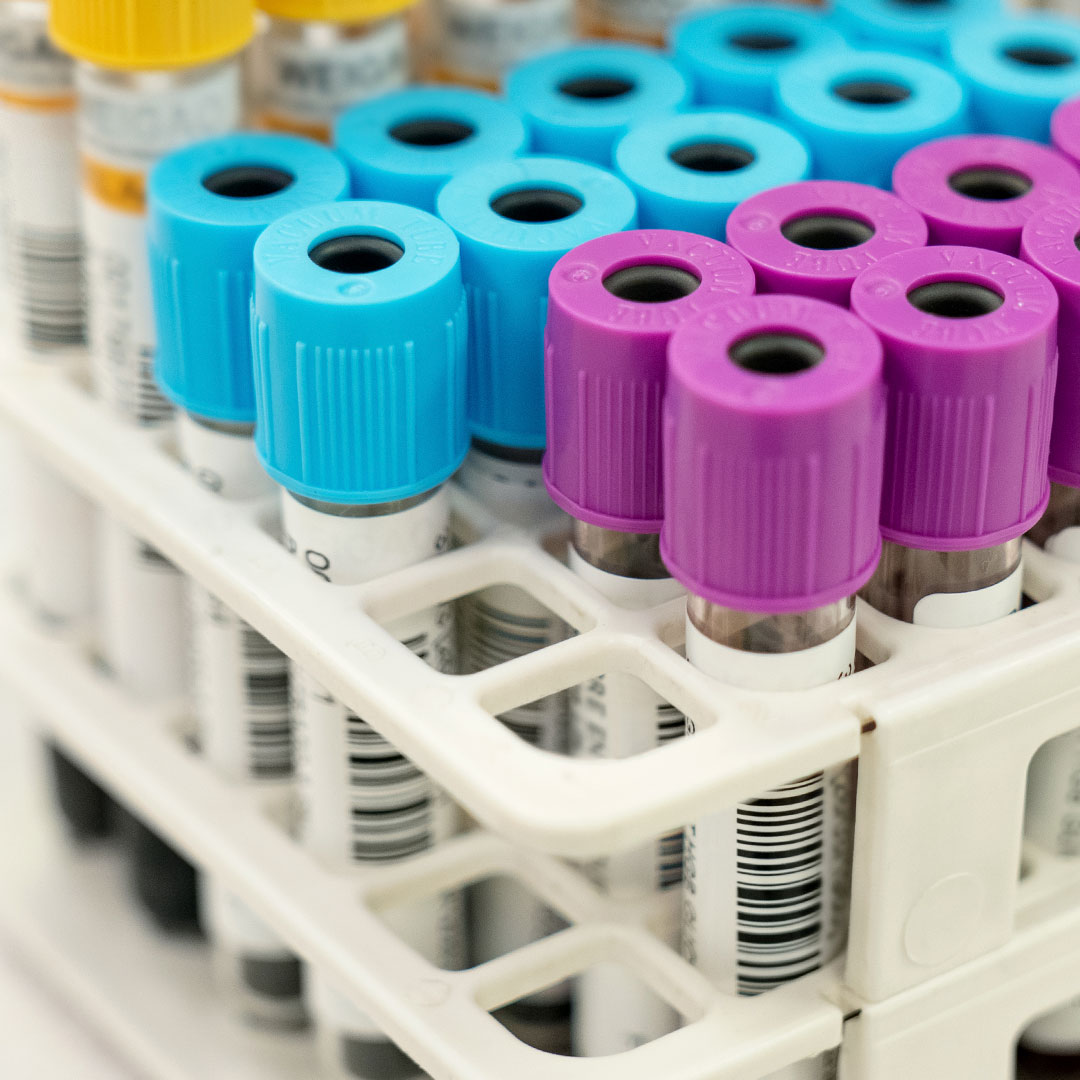 Close-up of test tubes with blue and purple caps organized in a white plastic rack, commonly used for blood samples in a medical or laboratory setting.